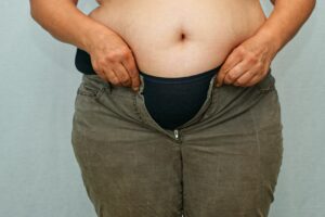 Fettabsaugung bei Übergewicht
